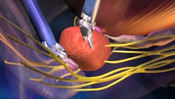 Photograph of microscopic prostate removal surgery using Da Vinci robot, involving nerve sparing